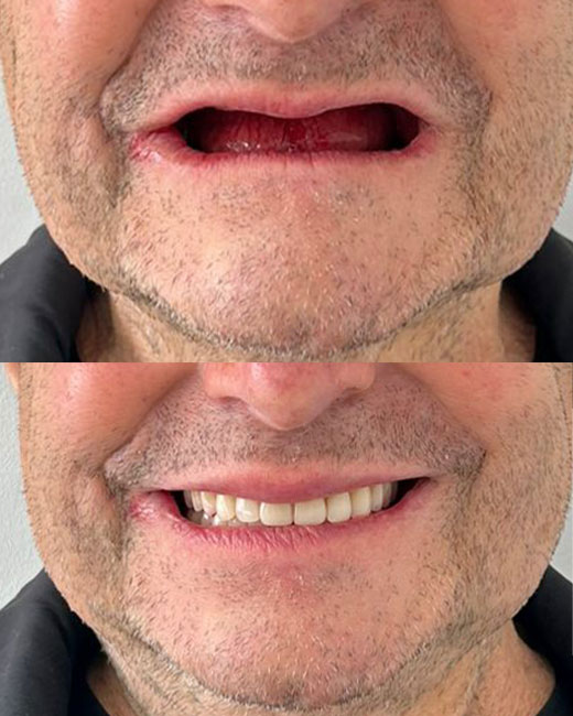 Caso de transformação com implante dentário 1