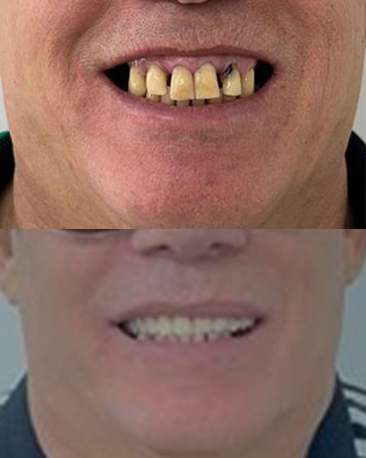 Caso de transformação com implante dentário 3