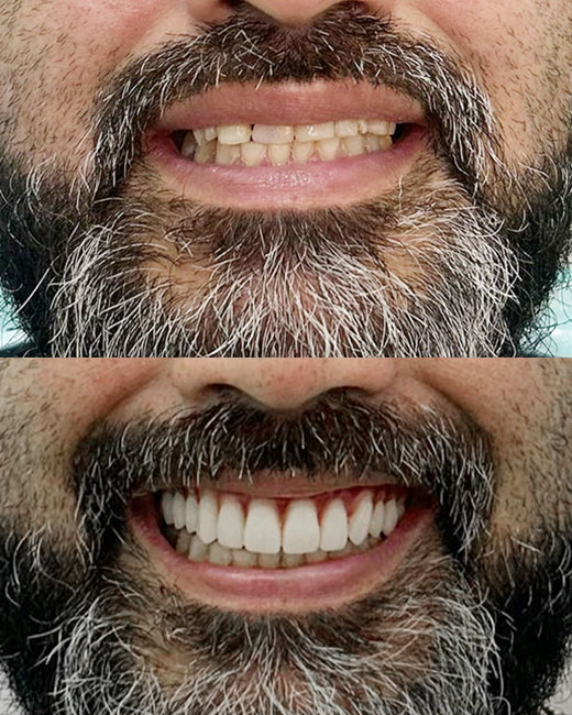 Caso de transformação com implante dentário 4